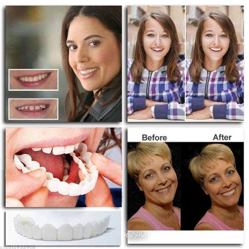 SnapSmile | Snap-On Dentures