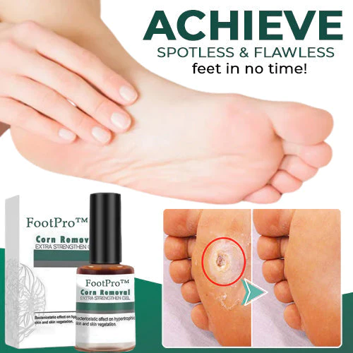 FootPro™ | Corn Removal Gel – Painless, fast, and effective gel for gentle foot care and callus removal