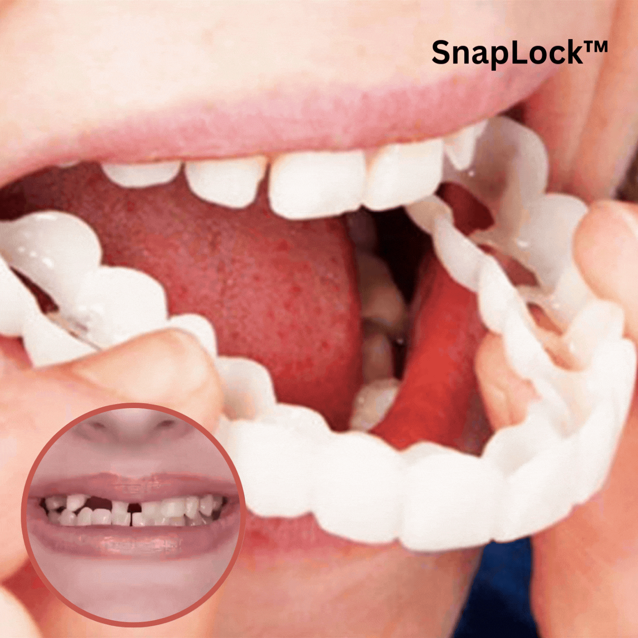 1+1 Free | SnapLock™ | Snap-on dentures