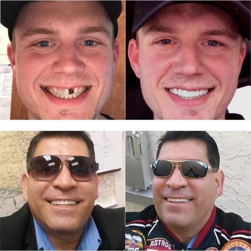 SnapSmile | Snap-On Dentures