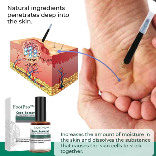 FootPro™ | Corn Removal Gel – Painless, fast, and effective gel for gentle foot care and callus removal