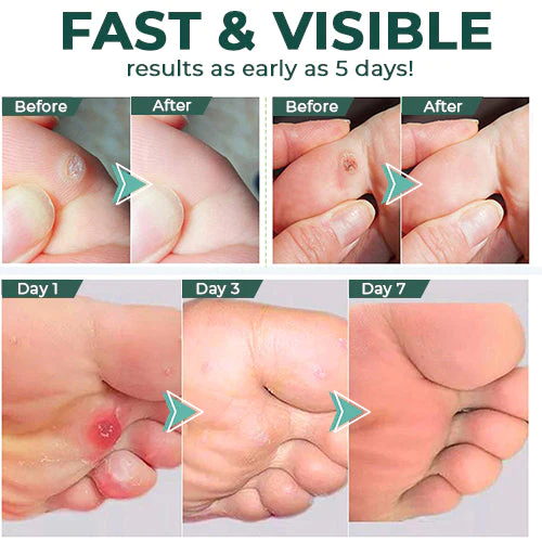 FootPro™ | Corn Removal Gel – Painless, fast, and effective gel for gentle foot care and callus removal